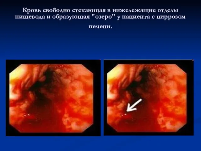 Кровь свободно стекающая в нижележащие отделы пищевода и образующая "озеро" у пациента с циррозом печени.