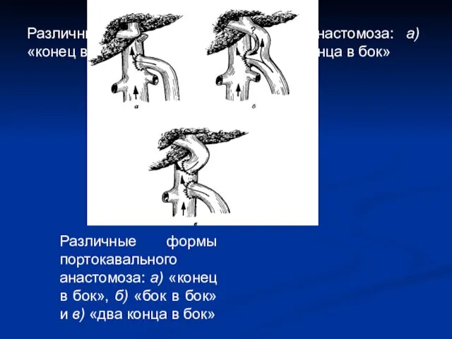 Различные формы портокавального анастомоза: а) «конец в бок», б) «бок в бок» и