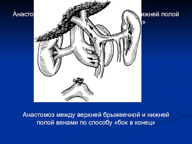 Анастомоз между верхней брыжеечной и нижней полой венами по способу «бок в конец»