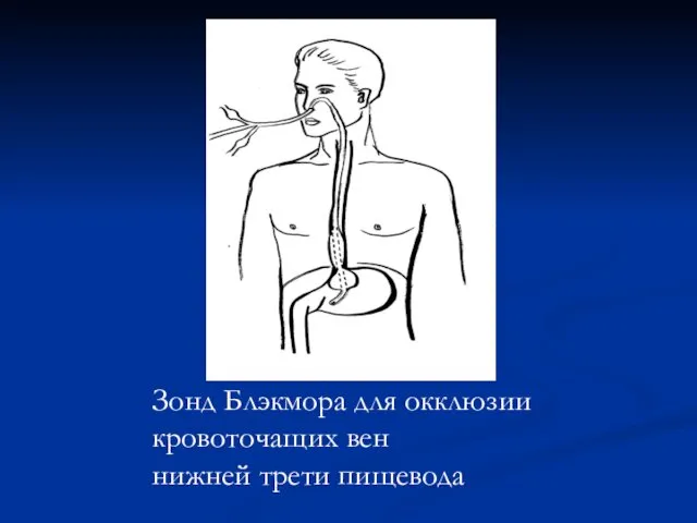 Зонд Блэкмора для окклюзии кровоточащих вен нижней трети пищевода