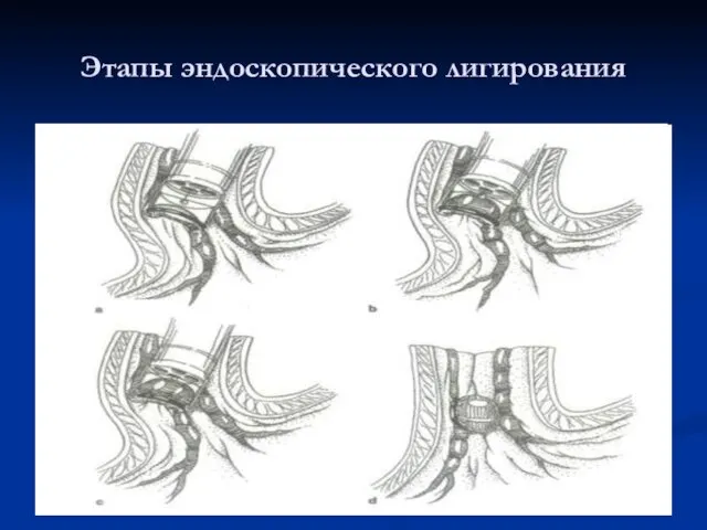 Этапы эндоскопического лигирования