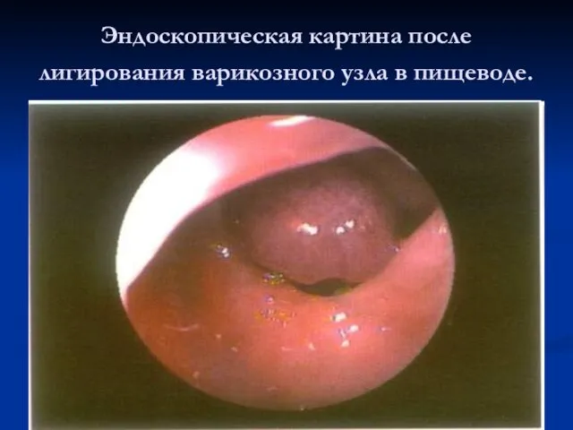 Эндоскопическая картина после лигирования варикозного узла в пищеводе.