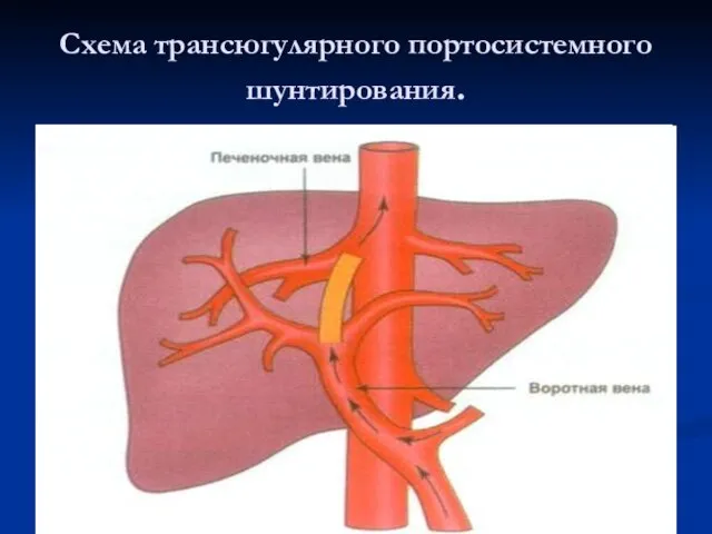 Схема трансюгулярного портосистемного шунтирования.