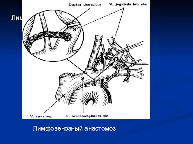 Лимфовенозный анастомоз