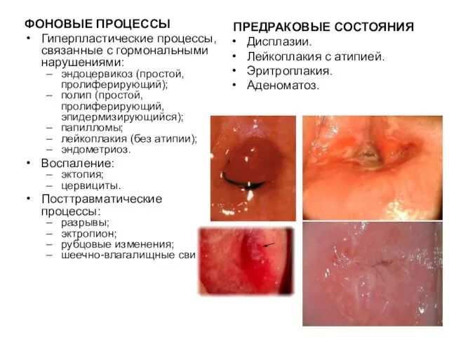 ФОНОВЫЕ ПРОЦЕССЫ Гиперпластические процессы, связанные с гормональными нарушениями: эндоцервикоз (простой,