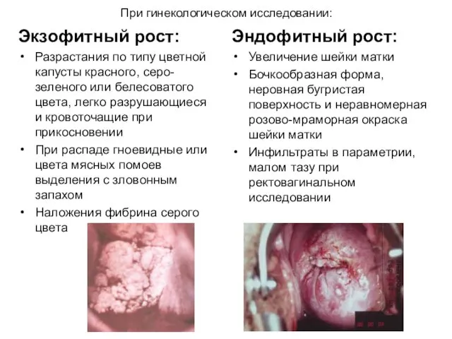 При гинекологическом исследовании: Экзофитный рост: Разрастания по типу цветной капусты