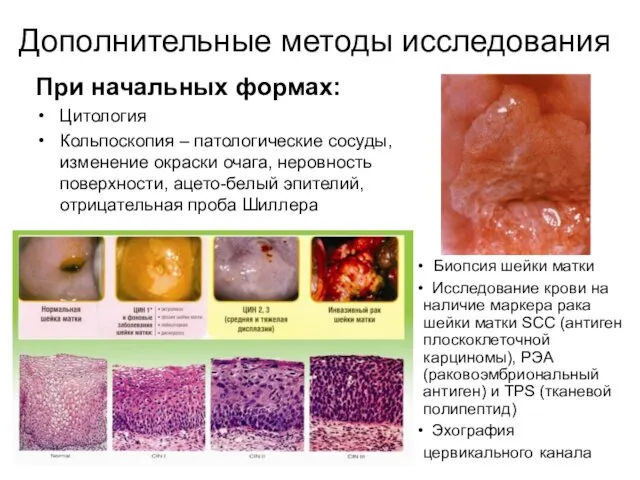 Дополнительные методы исследования При начальных формах: Цитология Кольпоскопия – патологические