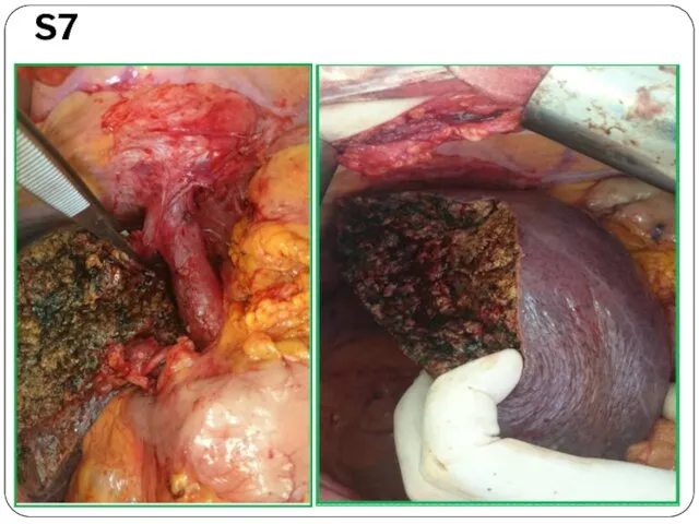 Гемигепатэктомия слева + S1+ S7