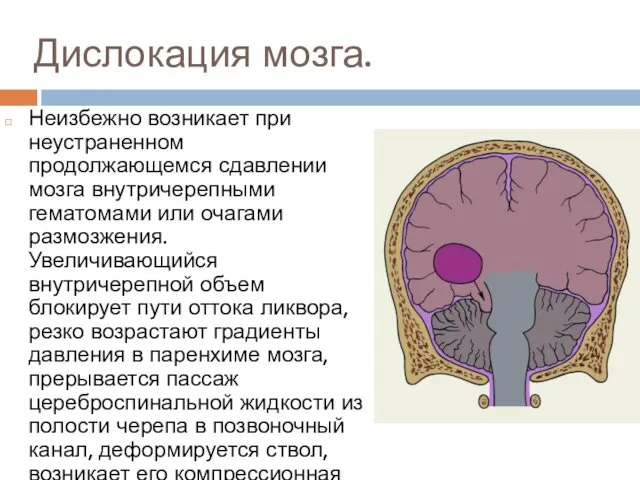 Дислокация мозга. Неизбежно возникает при неустраненном продолжающемся сдавлении мозга внутричерепными