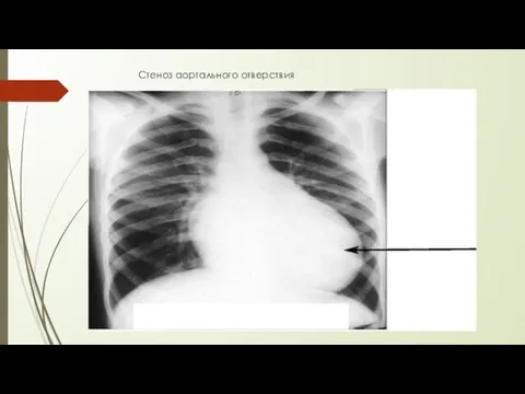 Стеноз аортального отверствия