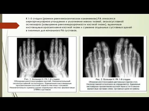 К 1-й стадии (ранним рентгенологическим изменениям) РА относятся периартикулярное утолщение