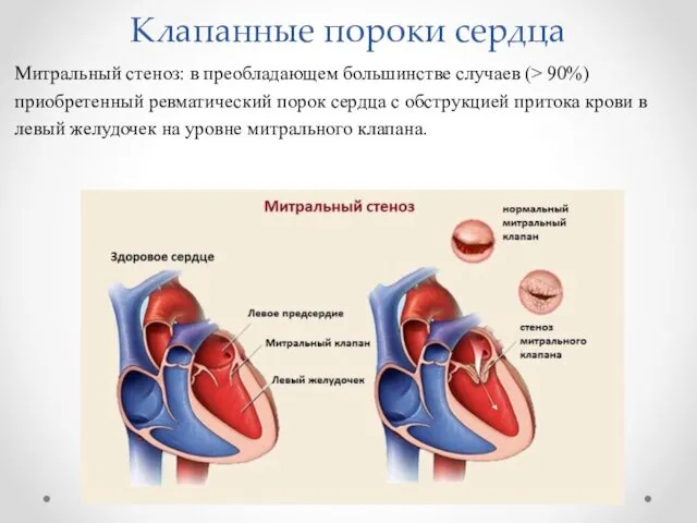 Клапанные пороки сердца Митральный стеноз: в преобладающем большинстве случаев (>