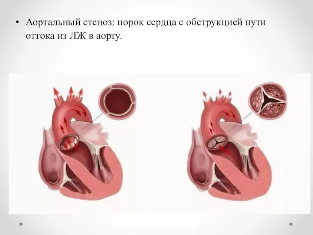 Аортальный стеноз: порок сердца с обструкцией пути оттока из ЛЖ в аорту.