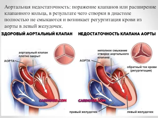 Аортальная недостаточность: поражение клапанов или расширение клапанного кольца, в результате