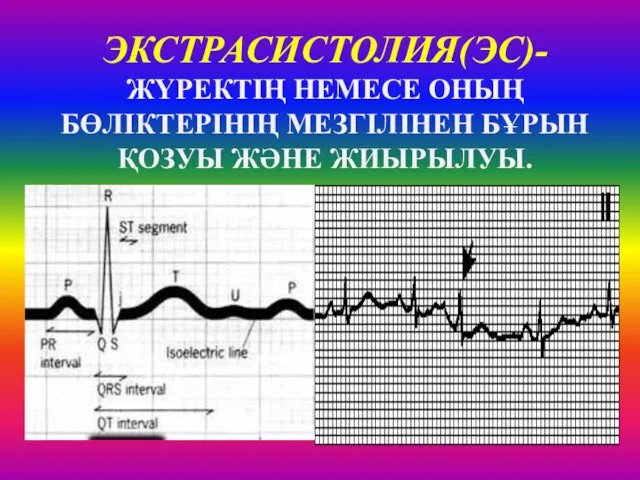 ЭКСТРАСИСТОЛИЯ(ЭС)- ЖҮРЕКТІҢ НЕМЕСЕ ОНЫҢ БӨЛІКТЕРІНІҢ МЕЗГІЛІНЕН БҰРЫН ҚОЗУЫ ЖӘНЕ ЖИЫРЫЛУЫ.