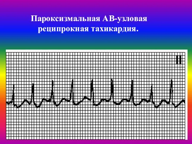 Пароксизмальная АВ-узловая реципрокная тахикардия.