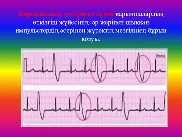 Қарыншалық экстрасистолия-қарыншалардың өткізгіш жүйесінің әр жерінен шыққан импульстердің әсерінен жүректің мезгілінен бұрын қозуы.