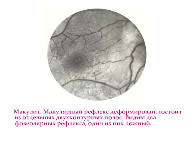 Макулит. Макулярный рефлекс деформирован, состоит из отдельных двухконтурных полос. Видны