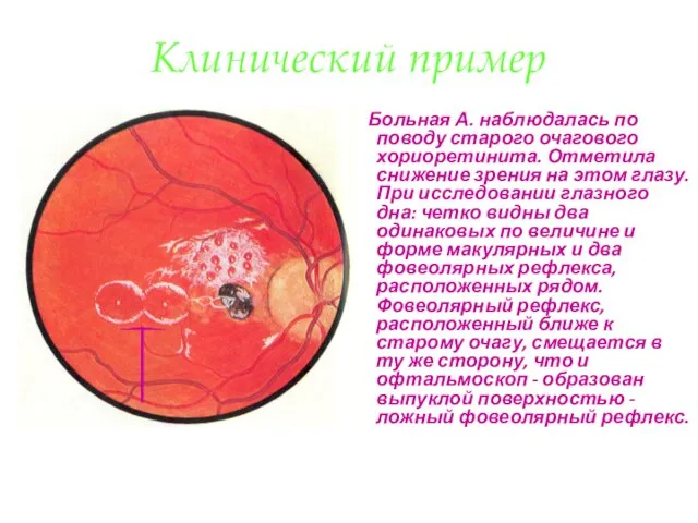 Клинический пример Больная А. наблюдалась по поводу старого очагового хориоретинита.