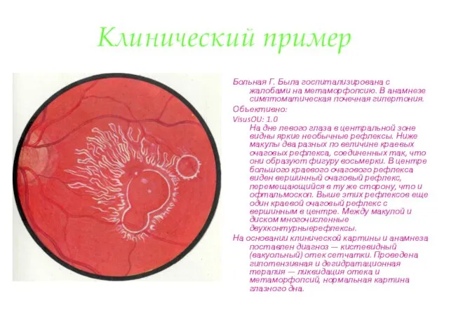 Клинический пример Больная Г. Была госпитализирована с жалобами на метаморфопсию.