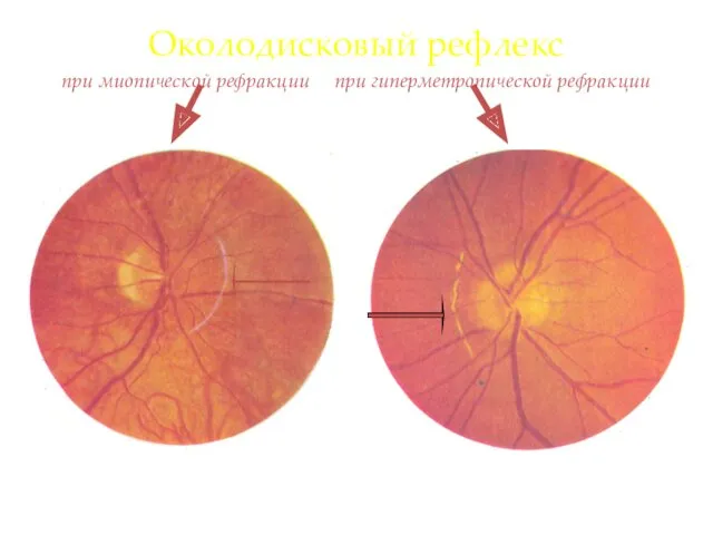 Околодисковый рефлекс при миопической рефракции при гиперметропической рефракции