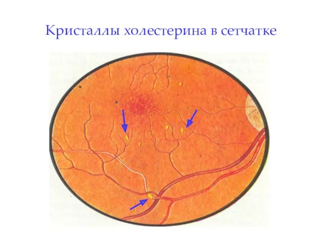 Кристаллы холестерина в сетчатке