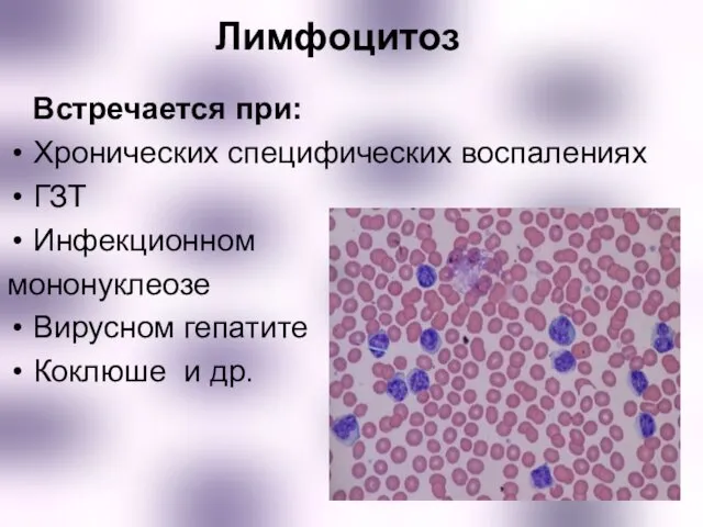 Лимфоцитоз Встречается при: Хронических специфических воспалениях ГЗТ Инфекционном мононуклеозе Вирусном гепатите Коклюше и др.