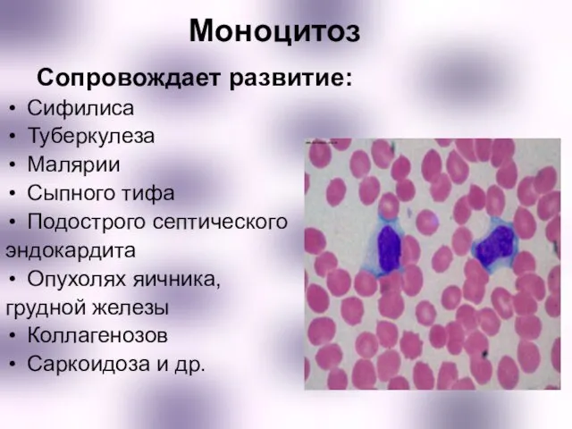 Моноцитоз Сопровождает развитие: Сифилиса Туберкулеза Малярии Сыпного тифа Подострого септического эндокардита Опухолях яичника,