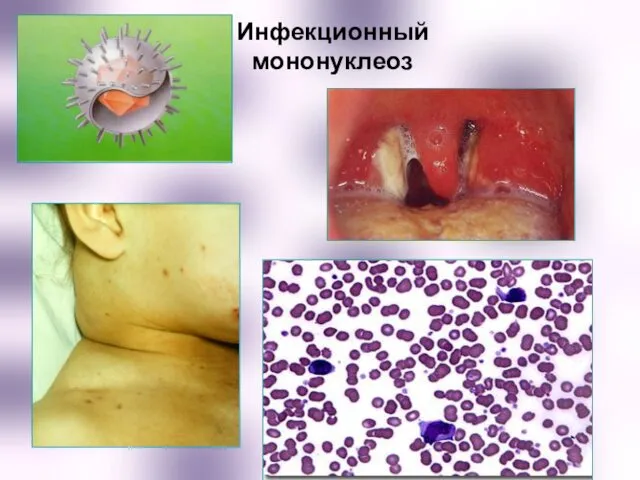 Инфекционный мононуклеоз