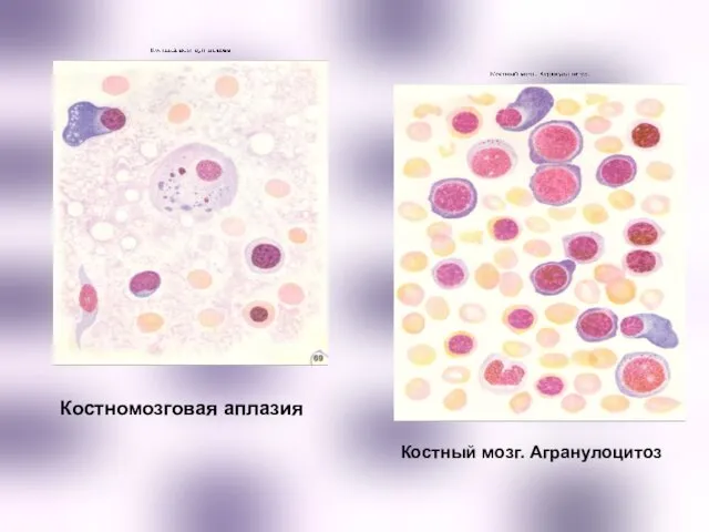 Костномозговая аплазия Костный мозг. Агранулоцитоз