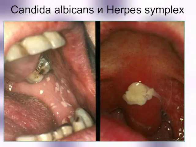 Candida albicans и Herpes symplex