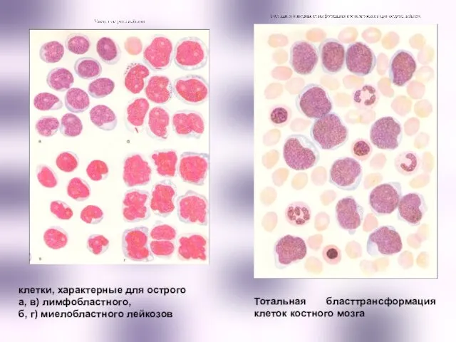 клетки, характерные для острого а, в) лимфобластного, б, г) миелобластного лейкозов Тотальная бласттрансформация клеток костного мозга