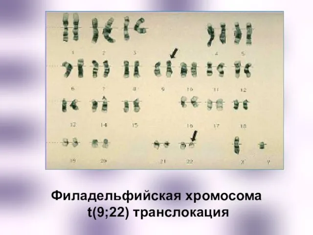 Филадельфийская хромосома t(9;22) транслокация