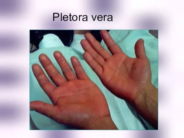 Pletora vera