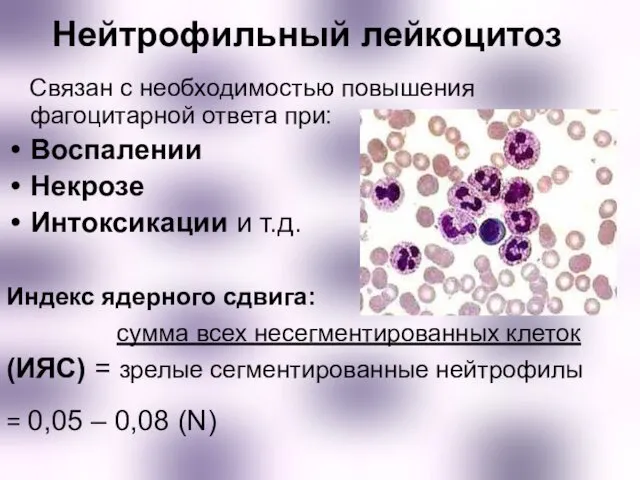 Нейтрофильный лейкоцитоз Связан с необходимостью повышения фагоцитарной ответа при: Воспалении Некрозе Интоксикации и