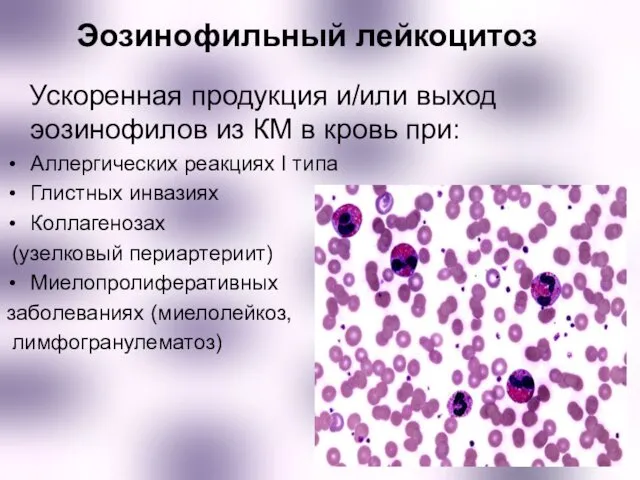 Эозинофильный лейкоцитоз Ускоренная продукция и/или выход эозинофилов из КМ в кровь при: Аллергических
