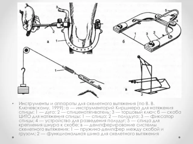 Инструменты и аппараты для скелетного вытяжения (по В. В. Ключевскому, 1999): а —
