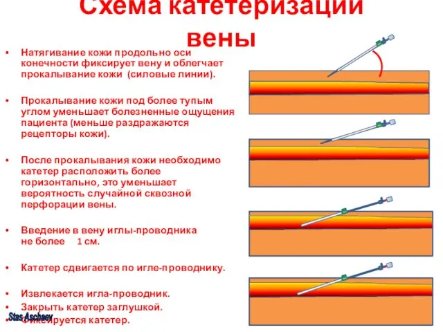 Схема катетеризации вены Натягивание кожи продольно оси конечности фиксирует вену