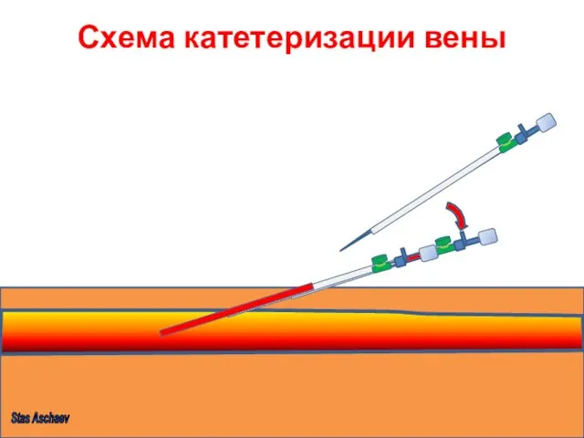Схема катетеризации вены Stas Aschaev