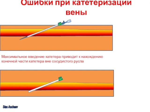 Ошибки при катетеризации вены Максимальное введение катетера приводит к нахождению