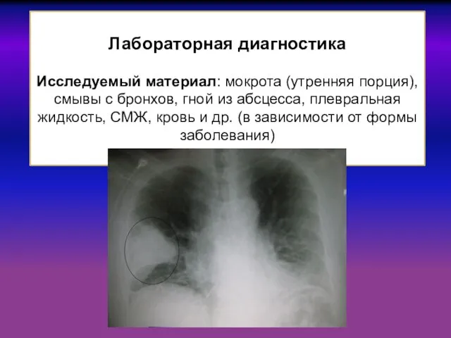 Лабораторная диагностика Исследуемый материал: мокрота (утренняя порция), смывы с бронхов,