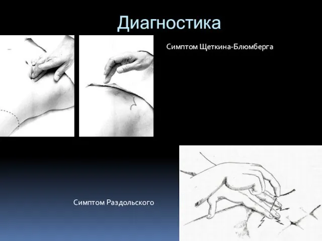 Диагностика Симптом Щеткина-Блюмберга Симптом Раздольского