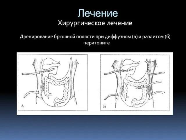 Лечение Хирургическое лечение Дренирование брюшной полости при диффузном (а) и разлитом (б) перитоните