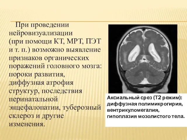 При проведении нейровизуализации (при помощи КТ, МРТ, ПЭТ и т. п.) возможно выявление