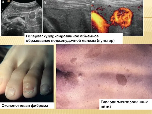 Гиперваскуляризированное объемное образование поджелудочной железы (пунктир) Гиперпигментированные пятна Околоногтевая фиброма