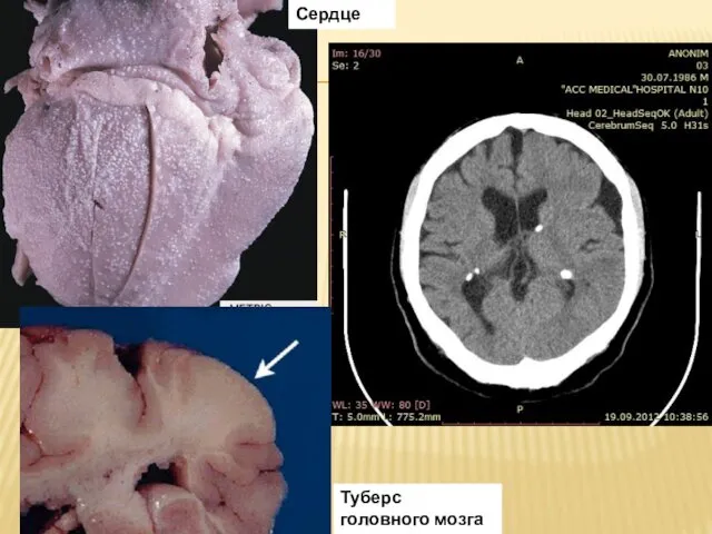 Туберс головного мозга Сердце