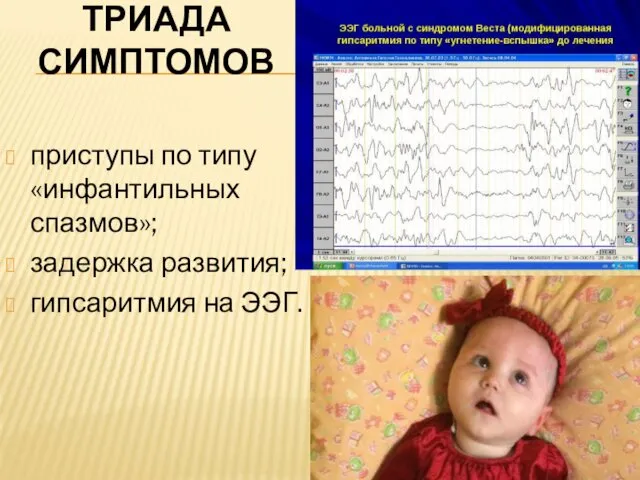 ТРИАДА СИМПТОМОВ приступы по типу «инфантильных спазмов»; задержка развития; гипсаритмия на ЭЭГ.