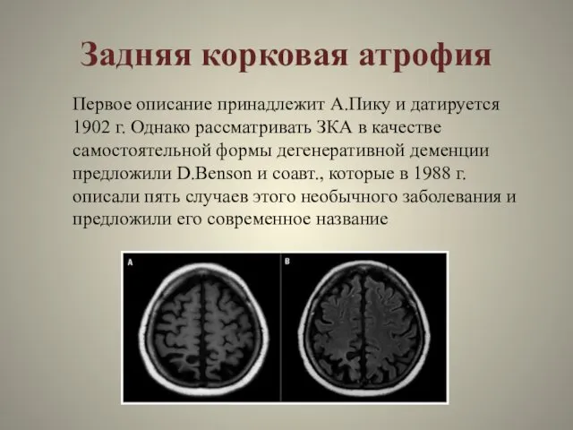 Задняя корковая атрофия Первое описание принадлежит А.Пику и датируется 1902