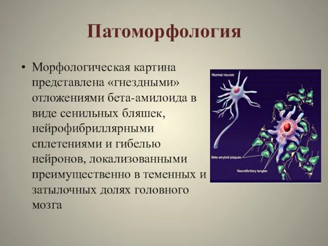 Патоморфология Морфологическая картина представлена «гнездными» отложениями бета-амилоида в виде сенильных