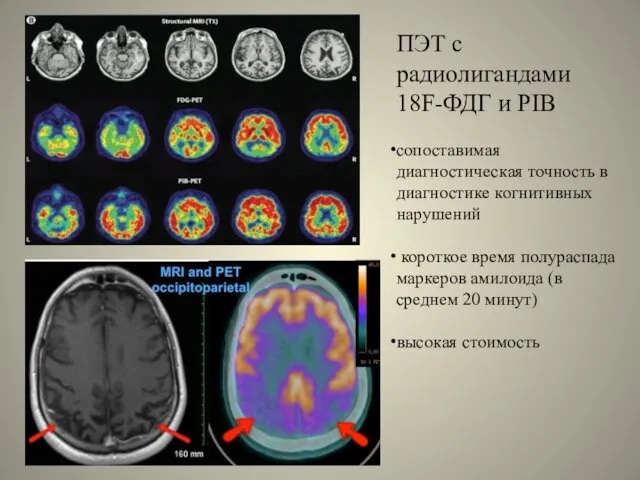 ПЭТ с радиолигандами 18F-ФДГ и PIB сопоставимая диагностическая точность в